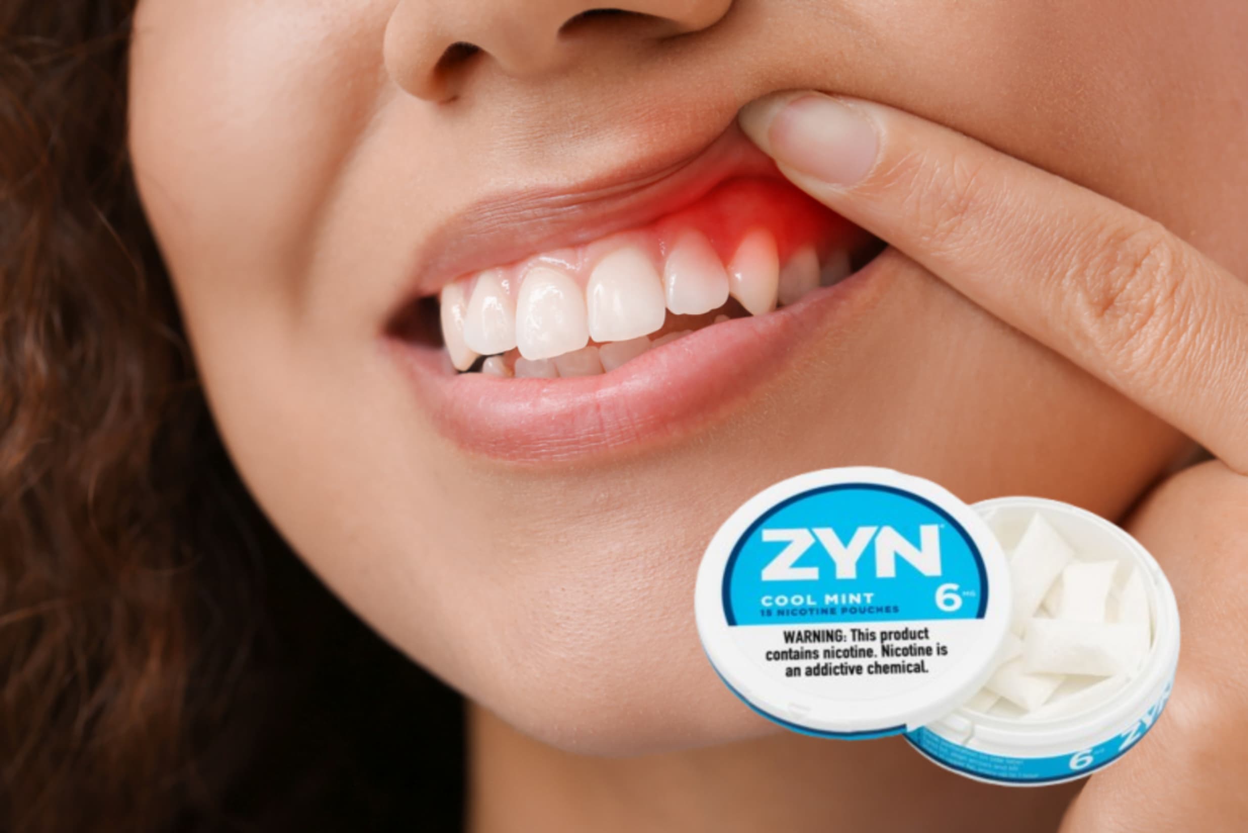 Zyn Nicotine Pouches: Impact on Gum Health Explained